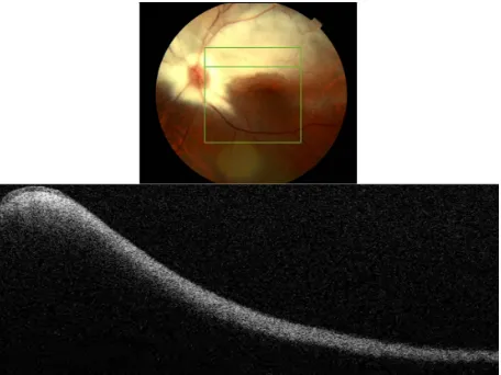 Figure 2 Fundus photograph (top) showing MRNF; the B-scan line on the fundus photograph has the same width as the B-scan SD-OCT image (bottom); SD-OCT image demonstrates thickened RNFL due to MRNF, thickness of which increases closer to the optic nerve hea
