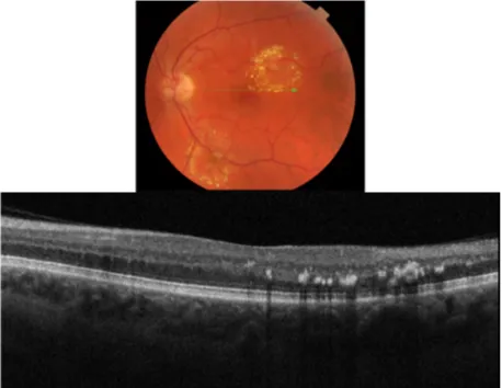 Figure 4 Fundus photograph (top) showing a circinate ring of exudates in the left eye of a patient with macroaneurysm; the B-scan line on the fundus photograph has the same width as the B-scan SD-OCT image (bottom); SD-OCT image demonstrates exudate deposi