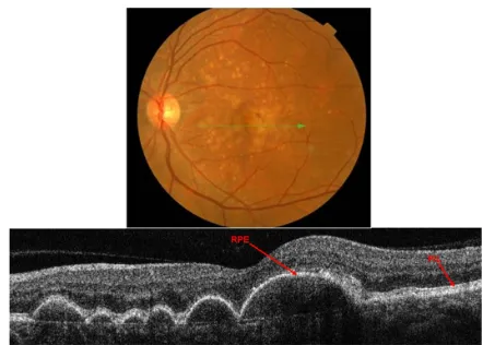 Figure 12 Fundus photograph (top) showing soft drusen in the left eye of a patient with ARMD; the B-scan line on the fundus photograph has the same width as the B-scan SD-OCT image (bottom) which demonstrates the appearance of soft drusen