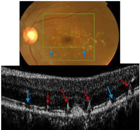 Figure 16 Fundus photograph (top) showing white FF flecks in the left eye of a patient with Stargardt disease; the B-scan line on the fundus photograph has the same width as the B-scan SD-OCT image (bottom) demonstrating areas of RPE migration (red arrows)