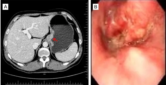 Figure 1. Mucosal destruction and stomach wall rigidity as indicated by the red arrow in the CT scan (A) and the gastroscope image (B), showing a large irregular mass at gastric cardia and gastric body