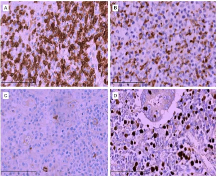 Figure 2. Morphology of Solitary Epstein-Barr Virus-positive Cytotoxic T Cell Lymphoproliferative Disease in Stomach