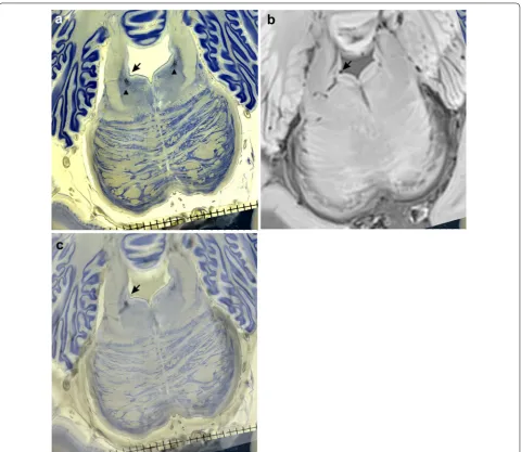 Fig. 4 a Celloidin‑embedded gallocyanin‑stained 420‑μm‑thick horizontal brainstem section of a 85‑year‑old female case