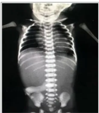 Figure 1: Chest X ray showing coiling of NG tube with  gasless abdomen suggestive of pure                