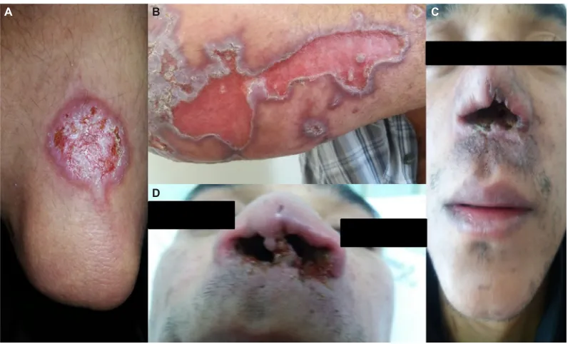 Figure 1 Life cycle of Leishmania into the vertebrate and invertebrate host.Note: Image modified from Centers for Disease Control and Prevention