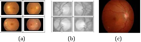 Fig.3. Processes in Detection of Exudates (a) Four Retina Images (b) Four ODs for Template (c) Input Retina Image (d) OD Detected Image (e) Eliminated OD Image (f) Green Channel OD Eliminated Image (g) Extracted Exudates  
