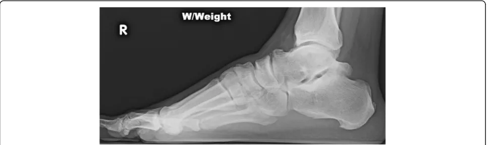 Fig. 2 A lateral radiograph demonstrates a large os trigonum