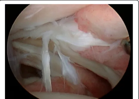 Fig. 4 a An arthroscopic image demonstrates anterolateral scar impingement with associated synovitis