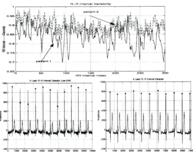 Figure 2.4: RR Interval Variability and RR Detection 