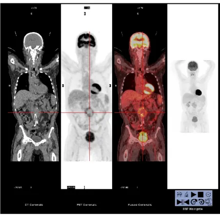 Figure 1. PET-CT scan of patient A. Coronal images displaying increased metabolic uptake at the site of the abdominal aortic aneurysm
