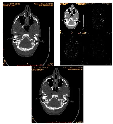 Fig.1 Compression of MRI image using Wavelet Decomposition  