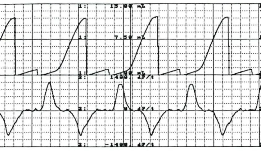 Figure AS. A recording of aortic flow and mean aortic flow after the heart cuff (bladder empty) was placed on the heart during trial #2 