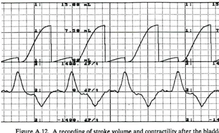Figure A 13. A recording of aortic flow and mean aortic flow at the start of assisting every other beat during trial #2 