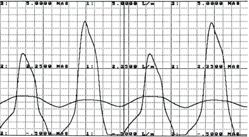 Figure A 16. A recording of stroke volume and contractility at the start of 