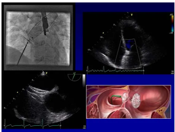 Figure 5. Echocardiogram, fluoroscopy and image of balloon mitral valvotomy.             