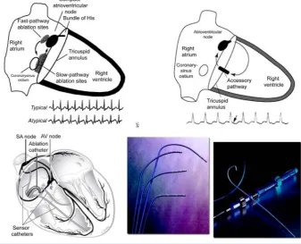 Figure 6. Aberrant pathways and catheters of electrophysiological studies.                 