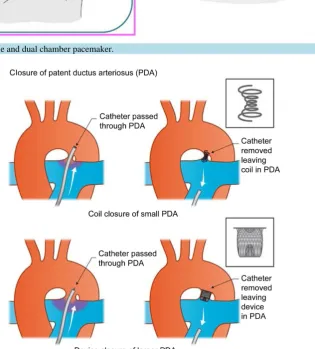 Figure 7. Single and dual chamber pacemaker.                                                       