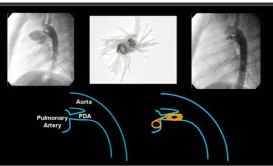 Figure 9. Fluroscopic image of patent ductus arteriosus closure with coil embolisation