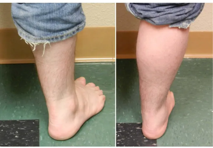 Figure 1. Patient ankle before and after Evans procedure with human amniotic allograft
