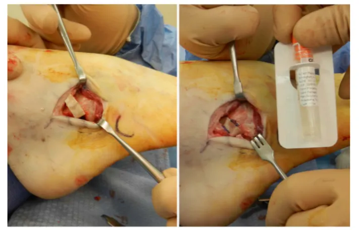 Figure 3. Evans procedure postoperative with (a) incomplete incorporation for graft at ap-proximately 11 weeks and (b) complete incorporation of graft at approximately 14 weeks