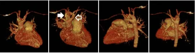 Figure 2. Chest computed tomography showed double aortic arch. Coronal view (A); Sagital view, right aortic arch (black arrow), left aotic arch (unfilled arrow) (B)