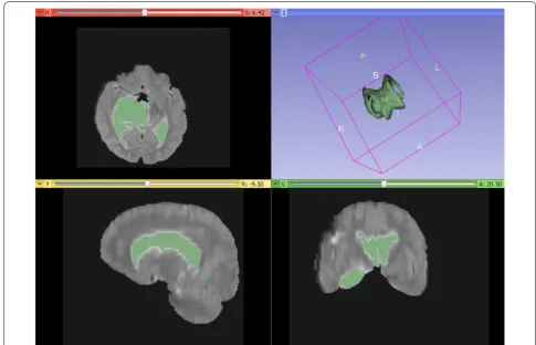 Fig. 7 Experimental result of watershed segmentation (from top to bottom). all slices with the tumor in 3D, watershed result of brain tumor image (red slice only), tumor in 3D view only