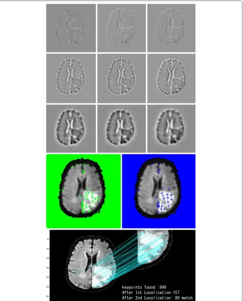 Fig. 8 Experimental result of SIFT segmentation (from top to bottom). Finding features of input MR brain tumor image, finding keypoints; the density of green signs and the blue signs on the tumor area indicate the tumor region; keypoints are localized, and then, find matching and lastly find 89 matches between the input and the output image, thus confirming the tumor area from the binary image