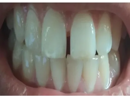 Fig-2: Teeth after dental care. 