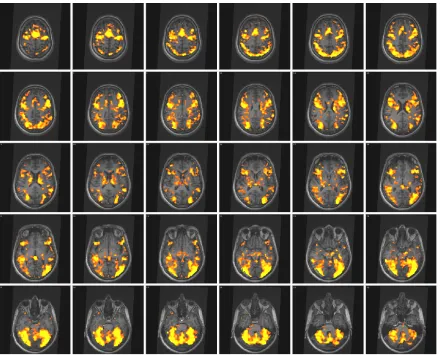 Figure 26: Cortical activation Brand1, elderly participants. Displayed in axial view, radiological convention