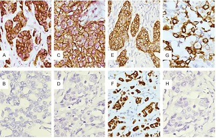 Figure 1. A. Cytoplasmic immunostaining of CK5/6; B. Negative control for CK5/6 by omission of the primary anti-body; C