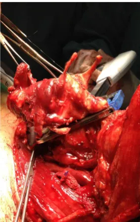 Figure 2. Mechanical suture of the pharynx.                            