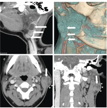 Figure 1 The multiple tuberculous lesions of right parotid nodes are linearly arranged on sagittal cT image.Notes: Tuberculosis of the left parotid lymph node in a 28-year-old female
