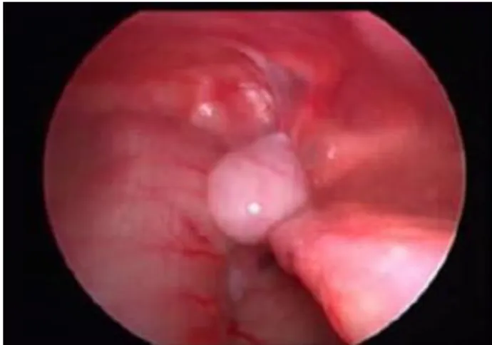 Table 2: Location of undescended testes according to  the age distribution.   
