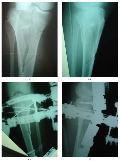 Figure 1. (a), (b): Scatzker VI fracture. Pre operative X-rays AP and Lateral; (c), (d): Same fracture treated with combina-tion of hybrid external fixator with one percutaneous canulated screw