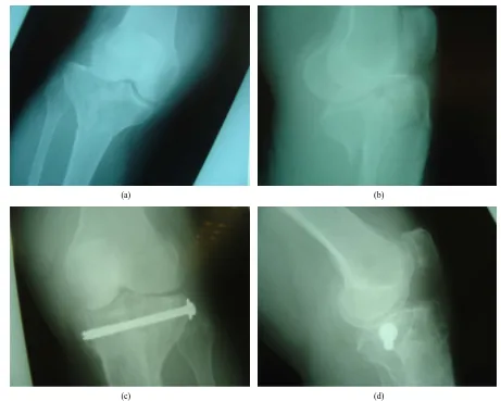 Figure 2. (a), (b): Schatzker IV fracture. Pre operative X-rays AP and Lateral; (c), (d): The fracture was treated with combina-tion of hybrid fixator with one canulated screw