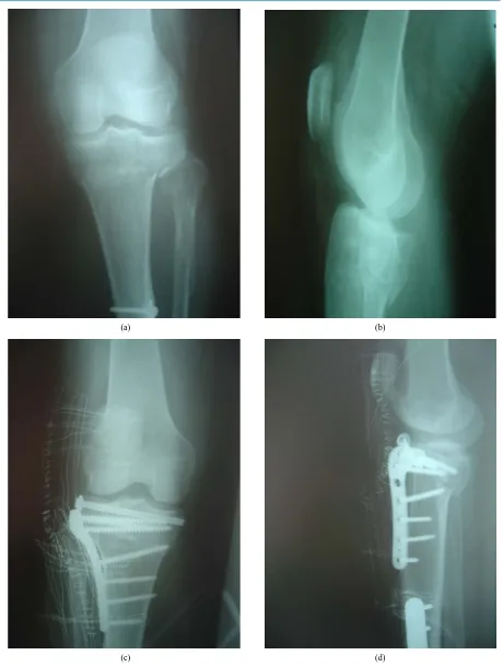 Figure 3. (a), (b): Schatzker VI fracture. Pre operative X-rays AP and Lateral; (c), (d): The fracture was treated with combi-nation of canulated screw and anatomic locking plate because of presence of previous metal ware