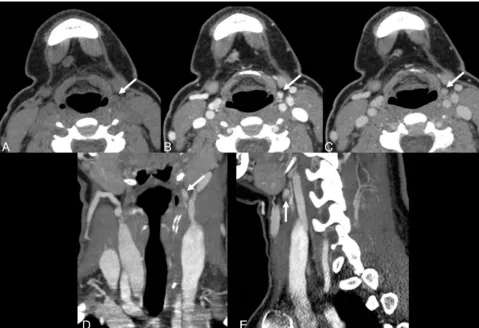 FIG 2. A 26-year-old woman with persistent primary hyperparathyroidism after undergoing a 7-hour neck exploratory procedure including theupper mediastinum and a left hemithyroidectomy, as the left inferior gland could not be found