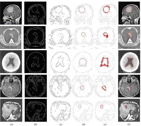 Figure 8. (a) Five different medical images; (b) Edge extraction by wavelet transform; (c) Edge map; (d) Initial contour po-sition outside the interested region; (e) The convergence of a deformable contour using GVF external forces; (f) Final result of the