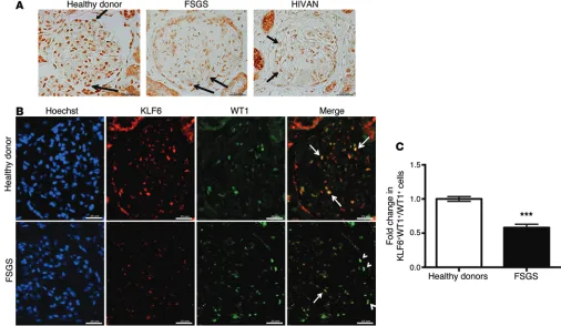 Figure 11. Reduced KLF6 expression in human HIVAN and FSGS. (A) Immunostaining for KLF6 performed on healthy donor nephrectomy specimens shows a nuclear distribution in podocytes and parietal cells, with a nuclear and cytosolic distribution in tubular cell