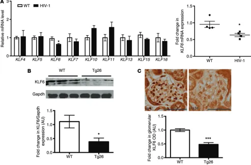 Figure 1. Strong association between KLF6 and the glomerulosclerosis was observed in HIVAN