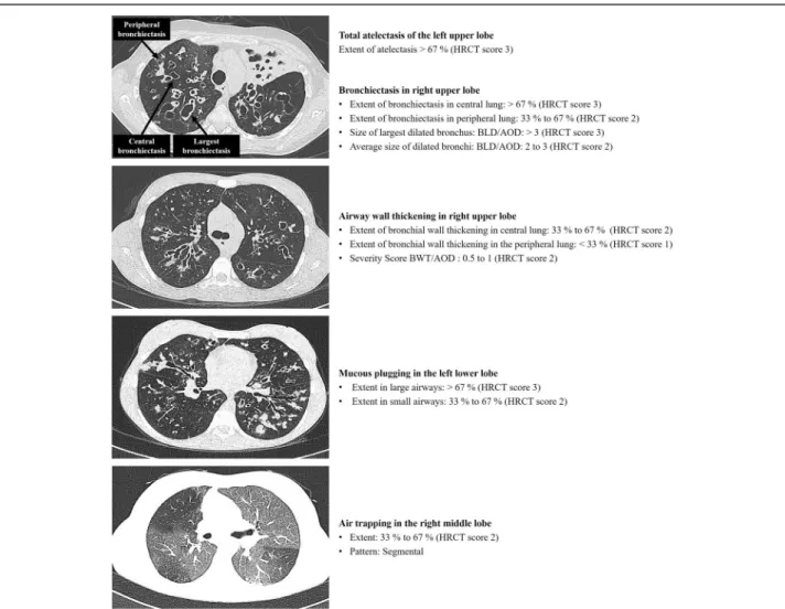 Fig. 1 Example of HRCT metrics according to the Brody II scoring system. Abbreviations: BLD indicates bronchial lumen diameter; AOD, adjacent pulmonary artery outer diameter; BWT, bronchial wall thickening