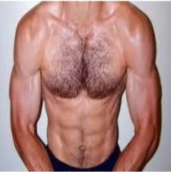 Figure 2.2  Androgenic hair pattern 