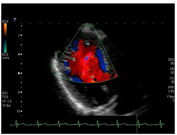 Table 7.  ECG findings.                                                                                      