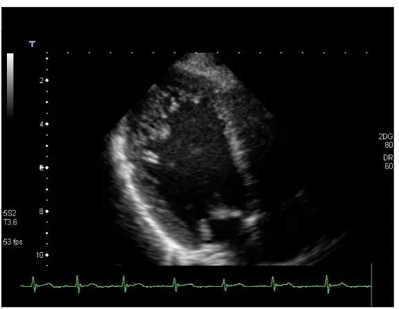 Figure 1. Transthoracic echocardiography, parasternal long axis, four-cham- ber view.                                                           