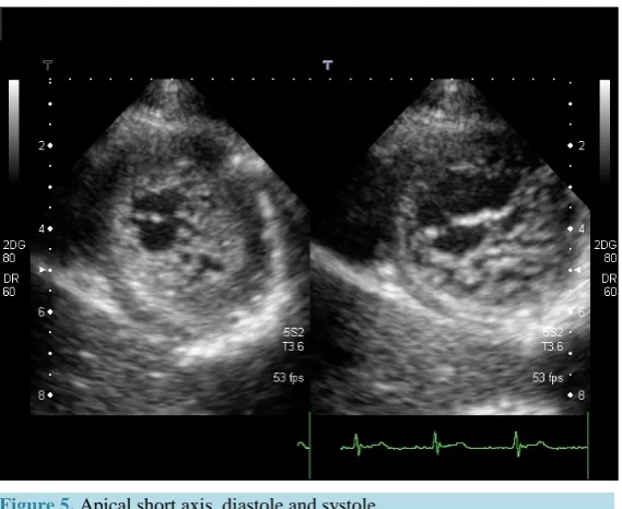 Figure 4. Apical short axis: Note the passage of blood flow between the tra-beculae.                                                         