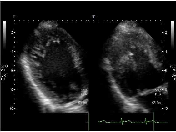 Figure 6. Two-chamber long axis view, diastole and systole.                 