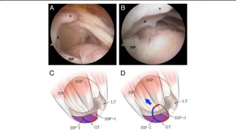 Fig. 2 a Intraoperative arthroscopy shows anteromedial retraction of the deep layer (d) in a delaminated rotator cuff tear