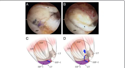 Fig. 5 aretracted bilaterally (type S3) (footprint of the infraspinatus [7],that the anterosuperior rotator cuff is detached from the greater tuberosity (longitudinal splitting between the supraspinatus and infraspinatus ( Intraoperative arthroscopy shows 