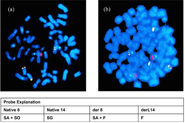 Figure 2. (Case 15) 5-year-old boy stage IV Burkitt’s lymphoma with complex karyotyping rearrangements and structural abnormalities in addition to the IGH/MYCC rearrangement