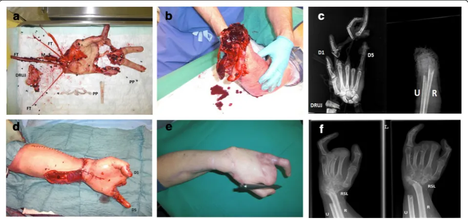 Fig. 1 aand adduction of the thumb in order to grip objects.and ringfinger were not re-plantable, the remaining defect (D) was temporarily covered by a negative pressure wound dressing and in a secondoperation 5 days later covered with split-skin-grafts.ex